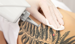 Media aandacht voor lasers bij verwijderen tatoeages