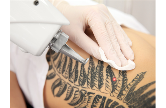 Media aandacht voor lasers bij verwijderen tatoeages