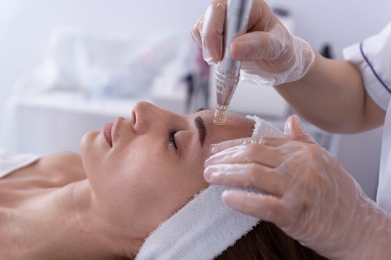 Opleiding Microneedling najaar 2024