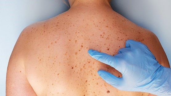 Workshop Verwijderen van huidoneffenheden - 30 jan 2026