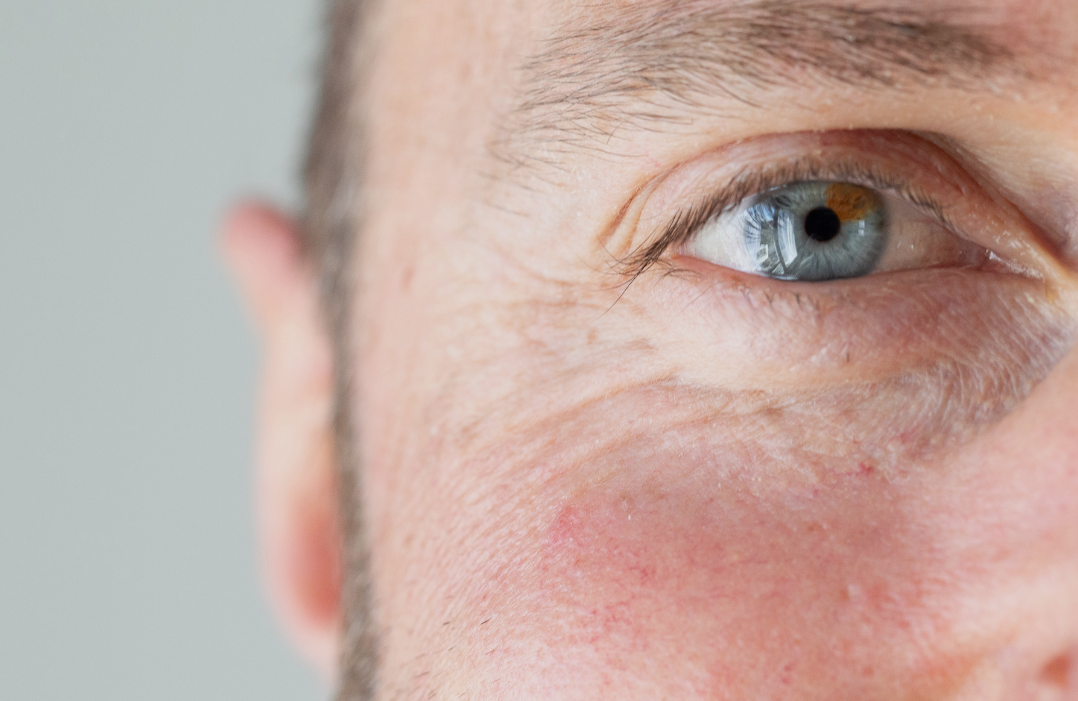 Masterclass Huidoneffenheden verwijderen met IPL - 29 okt. 2026